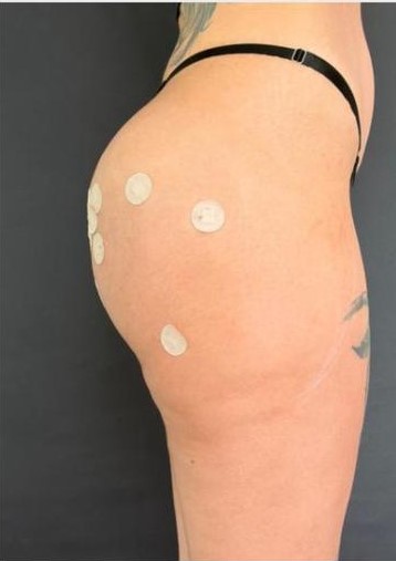 Depois: Transformação estética sem cirurgia